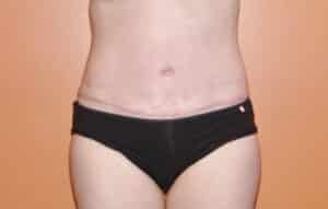 Abdominoplasty