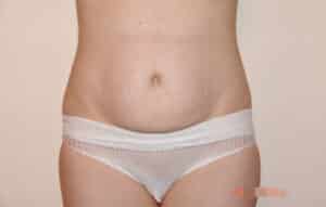 Abdominoplasty