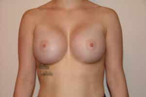 Breast Augmentation