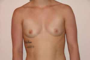 Breast Augmentation