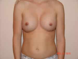 Breast Augmentation