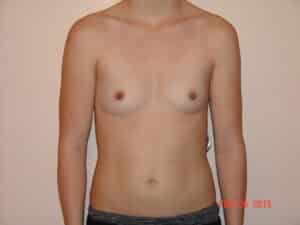 Breast Augmentation